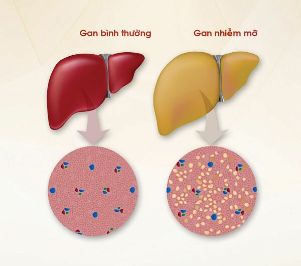 roi loan mo mau gay gan nhiem mo, rối loạn mỡ máu gây gan nhiễm mỡ