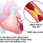 Nguyên nhân gây xơ vữa động mạch là gì? Điều trị xơ vữa động mạch