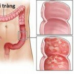 Bệnh viêm đại tràng là gì? Triệu chứng và cách điều trị viêm đại tràng