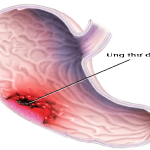 Cây hoàn ngọc và tác dụng chữa trị bệnh ung thư