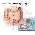 Quy trình nội soi đại tràng – những điều cần biết về nội soi đại tràng