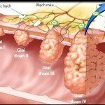 Ung thư đại tràng là gì? Triệu chứng và dấu hiệu bệnh ung thư đại tràng