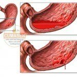 Xuất huyết dạ dày có nguy hiểm không?