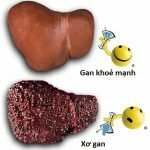 Gan nhiễm mỡ – Dấu hiệu nhận biết bệnh chưa biết